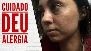 REAÇÃO ALÉRGICA COM PRODUTO DA AVON / LUIZA GOMES