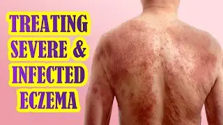 How To Manage Infected and Severe Eczema | Dupixent