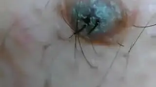 Вросший волос  в прыще