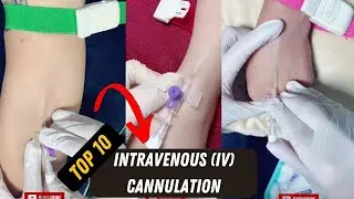 How To Insert IV Cannula | Top 10 Intravenous Cannulation Technique video | IV Cannula Procedure