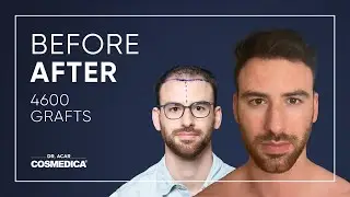 Hair Transplant in Turkey | Results | Dr. Acar | Cosmedica Clinic