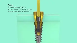 How to remove Nobel Biocare N1 abutments