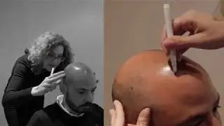 Así es como recuperé mi pelo - Caso real