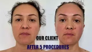 [14-MIN] LIFTING Massage for the whole face