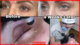Plasma Pen on Lower Eyelid for Fine Lines and Eye Lifting BEFORE AND AFTER (2024)