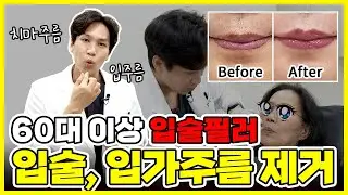 60대 이상 입술필러! 치마주름, 입가주름, 호두주름 제거시술