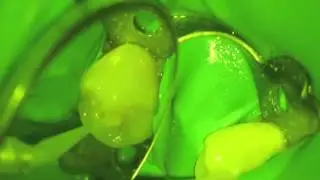 Simple Occlusal Filling under Microscope