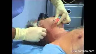LASEmaR 1500 - Jowl Lipolysis and Facial Contouring - Laser Lipolisi Guancia e Rimodellamento Ovale