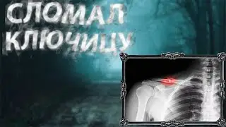 СЛОМАЛ КЛЮЧИЦУ, ВОССТАНАВЛИВАЮСЬ ⊳ CS 2 Stream