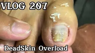 VLOG 207: Removal of severe Dead Skin and Ingrown! Satisfying and Relaxing #ingrownremoval