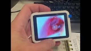 painful ear - image capture with ScopeAround device
