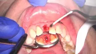 Socket Preservation