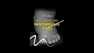 Caso Clínico: Biopolímeros en piernas