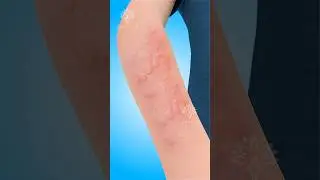 Hives: What Happens Inside Your Body 😮 