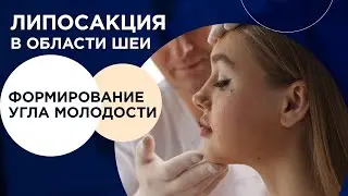 Зыков: Липосакция шеи. Формирование угла молодости на лице.