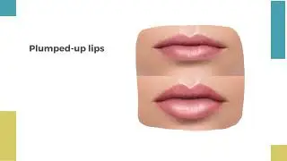Thinking of having Dermal Fillers? | CARE Esthetics