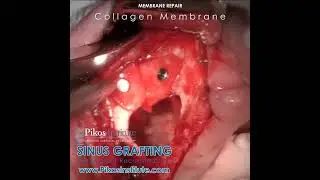 Perforated Schneiderian Membrane Repair Pikos Sinus Membrane Repair