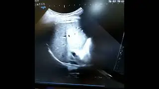 Cálculo por US de la Fracción Grasa en Hígado. PARTE 3.