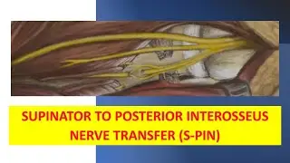 Supinator to Posterior Interosseus Nerve Transfer (SPIN)