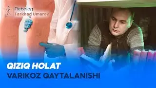 Qiziq holat  varikoz qaytalanishi