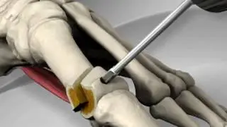 Hallux valgus. Chirurgie orthopédique Médipole près de Valence