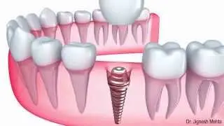Dental Implant