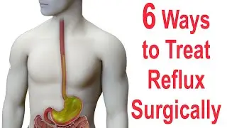 6 Ways to Surgically Treat Reflux (Nissen, Toupet, Dor, LINX, EsophyX, Stretta)