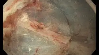 ESD of a rectal LST. Focus on the management of bleedings.