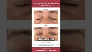 Üst Göz Kapağı Estetiği - Die Oberlidstraffung