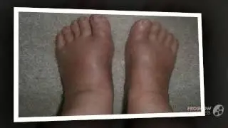 фиксатор valgus pro

  - Valgus Pro - средство от выпирающей «косточки»