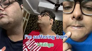 I'm suffering from 'Vitiligo' || Weightloss Problem || Weight Loss Journey