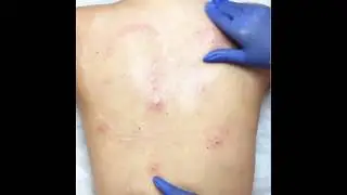 Чистка спины в Центре эстетики 