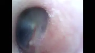 Is my Incus Bone is Pushing my Eardrum?