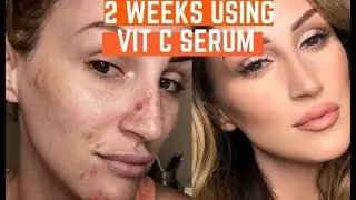 I USED VITAMIN C SERUM ON MY DARK SPOTS  FOR 2 WEEKS & THIS HAPPENED