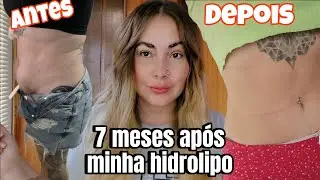 MINHA HIDROLIPO 7 MESES DEPOIS ! OLHA COMO ESTÁ MINHA BARRIGA