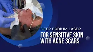 DEEP ERBIUM LASER FOR SENSITIVE SKIN WITH ACNE SCARS | Dr. Jason Emer
