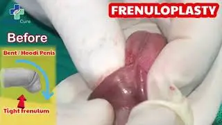 tight foreskin | frenulum breve | frenuloplasty #definitecure