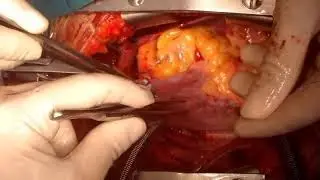 Repair of a Bicuspid Pulmonary Valve