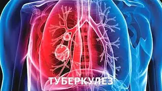 Туберкулез. Эпидемия