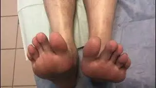 Лечение полного разрыва ахилла, 51 день