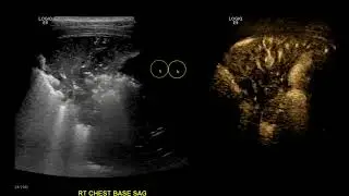 Consolidation vs Pleural Effusion