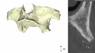dr.Giampiero Ciabattoni Digital Implantology Video Channel
