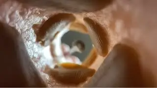 Limpeza de ouvido satisfatória! Satisfactory ear cleaning ASMR