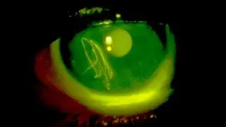 Fluorescein eye stain