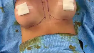 Breast Augmentation- Before and Immediately After