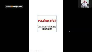 Polydactyly- additional finger in child