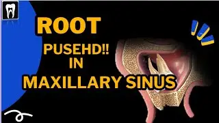 Root is inside the maxillary sinus | CBCT | Tooth extraction