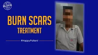 Patient Testimonial | Burn Scars | Clinical Dermatology | Dr. Nivedita Dadu