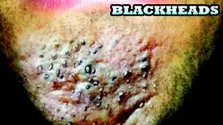 Trypophobia!  Dermatology, Popaholics & Extractor Tools!
