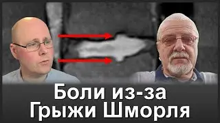 Мифы о Грыжах Шморля: Разоблачение хирургов